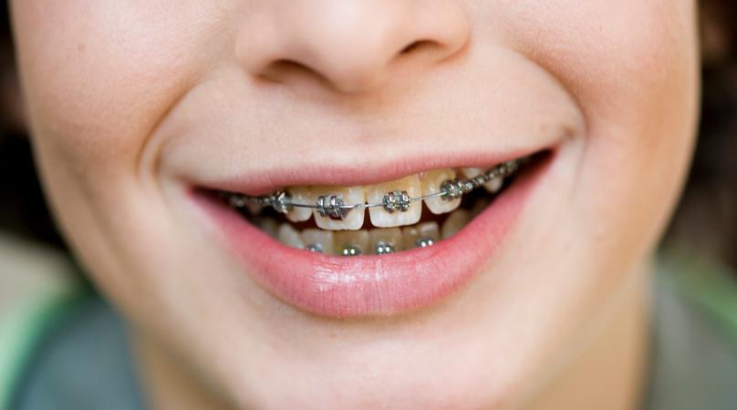 Close up mouth with brace